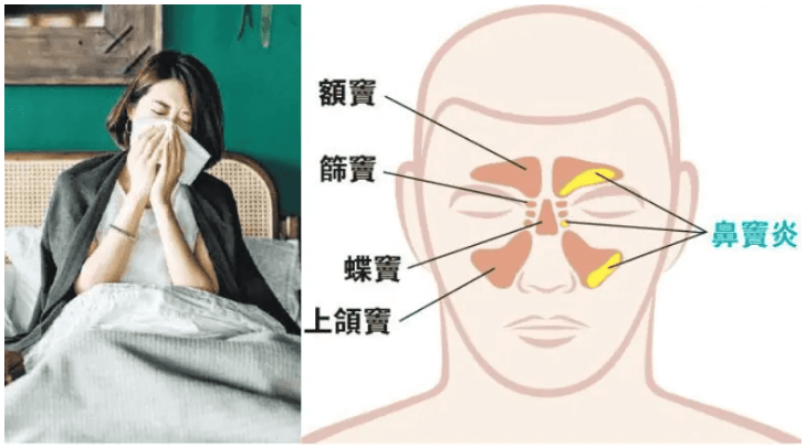 【鼻竇炎】持續鼻塞 鼻黏膜受炎症刺激增生鼻瘜肉致鼻水倒流 可致睡眠窒息失嗅覺